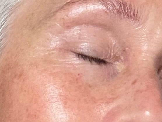 Close up image of dark spots on upper cheek and nose